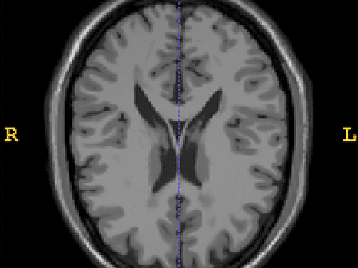 Efeito do Registro de Imagens em Lesões de EM